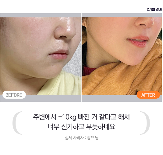 before after, 주변에서 -10kg 빠진 거 같다고 해서 너무 신기하고 뿌듯하네요 - 실제 사례자 : 강 ** 님