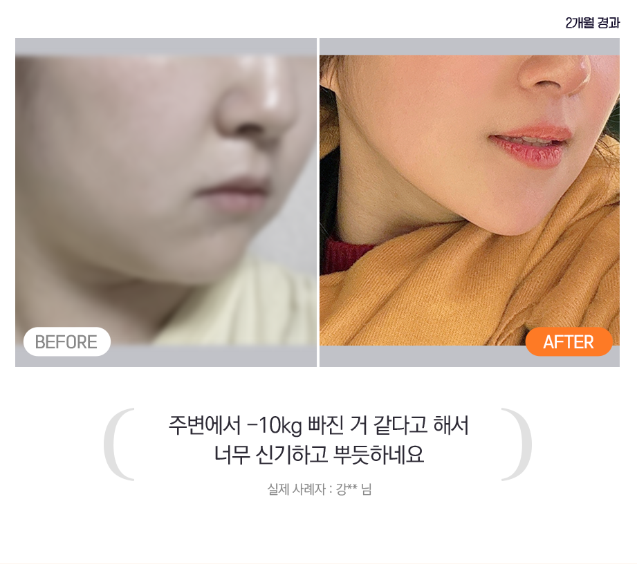 before after, 주변에서 -10kg 빠진 거 같다고 해서 너무 신기하고 뿌듯하네요 - 실제 사례자 : 강 ** 님