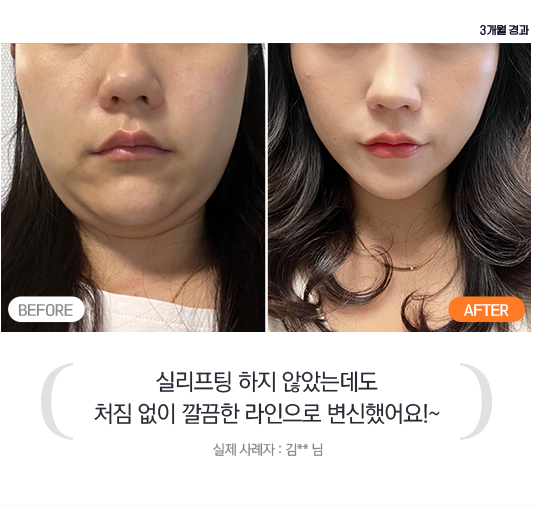 실리프팅 하지 않았는데도 처짐 없이 깔끔한 라인으로 변신했어요 !~ - 실제 사례자 : 김 ** 님