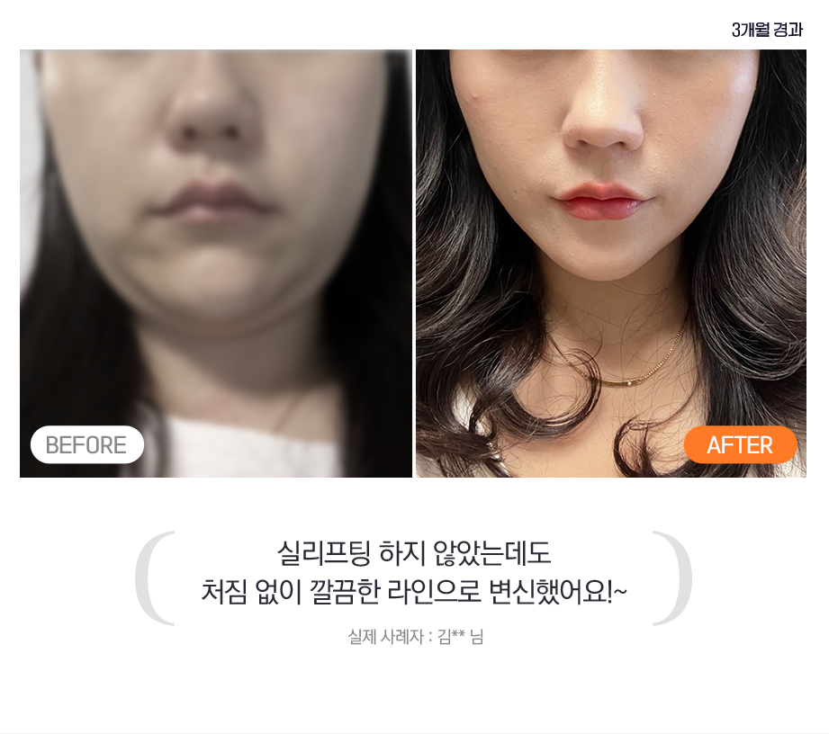실리프팅 하지 않았는데도 처짐 없이 깔끔한 라인으로 변신했어요 !~ - 실제 사례자 : 김 ** 님