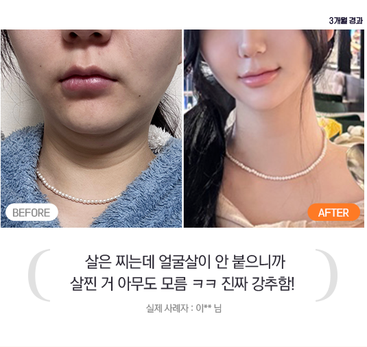 살은 찌는데 얼굴살이 안 붙으니까 살찐 거 아무도 모름 크크 진짜 강추함! - 실제 사례자 : 이 ** 님