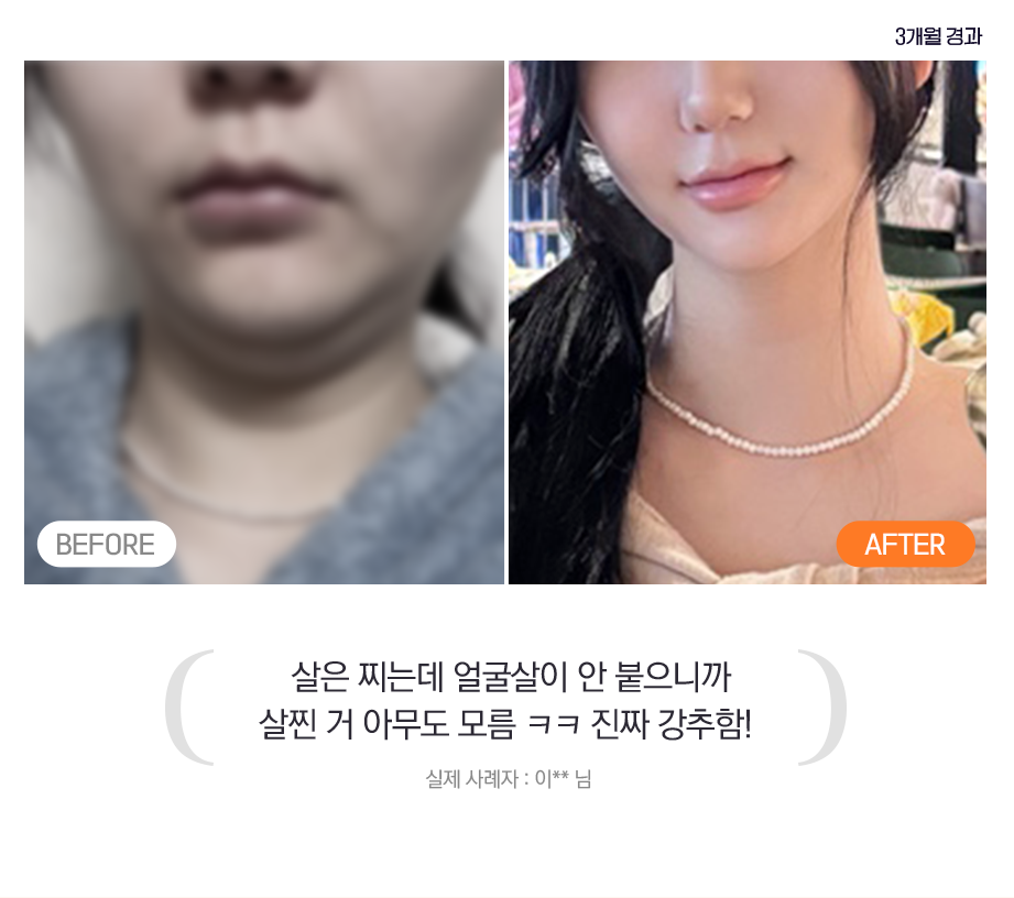 살은 찌는데 얼굴살이 안 붙으니까 살찐 거 아무도 모름 크크 진짜 강추함! - 실제 사례자 : 이 ** 님