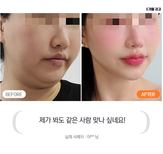 제가 봐도 같은 사람 맞나 싶네요! - 실제 사례자 : 이 ** 님