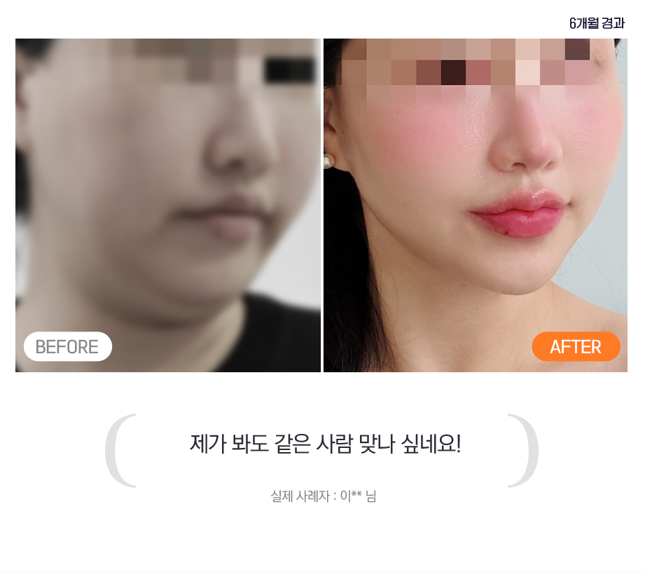 제가 봐도 같은 사람 맞나 싶네요! - 실제 사례자 : 이 ** 님